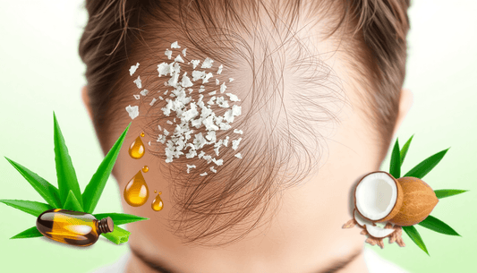 Natural Solutions for Dandruff: What Works Best? - VeroBreeze